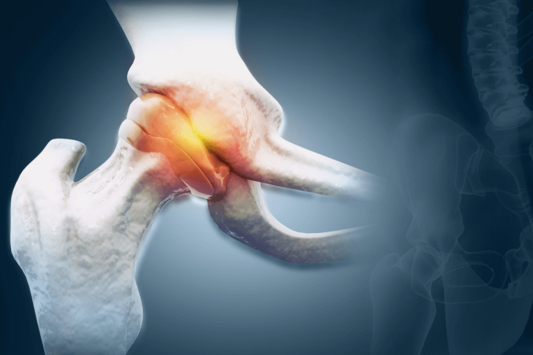 Ein Hüftgelenk mit Arthrose