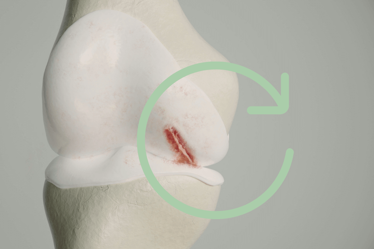 Ein Kniegelenk mit einem Knorpelschaden