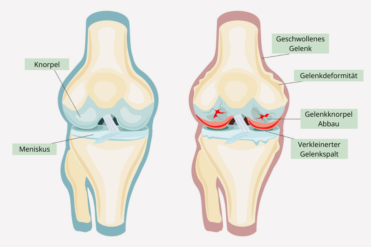 Eine anatomische Zeichnung von zwei Kniegelenken. Eine Zeichnung zeigt ein gesundes Kniegelenk und die andere Zeichnung von ein Kniegelenk mit Arthritis.